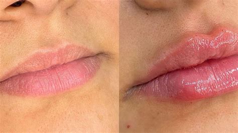 A Boca Volta Ao Normal Depois Do Preenchimento Labial - Preenchimento labial 2 ml antes e depois: veja os benefícios!