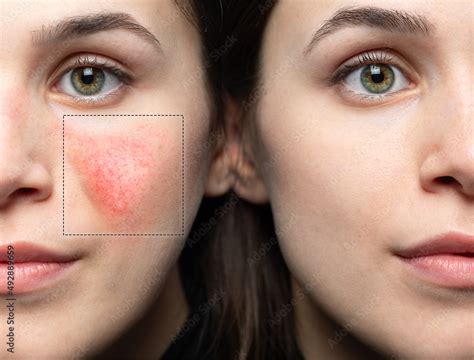 Rosacea before and after laser treatment. Stock Photo | Adobe Stock