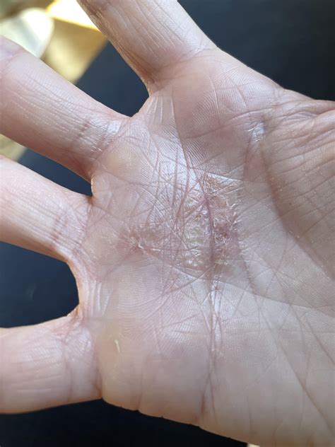 Weights at my gym activated my nickel allergy : r/Wellthatsucks