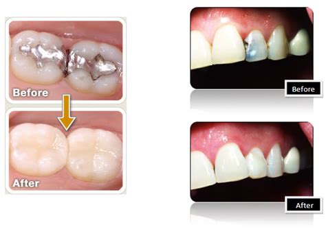 decaying teeth treatment