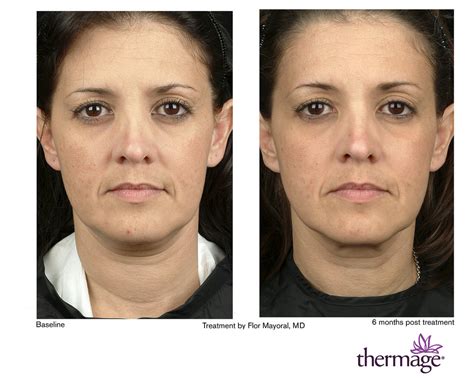 Before and After Face by Thermage™