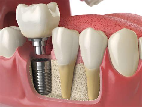 What to Expect During the Recovery Process After Dental Implants in