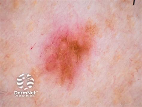 Dermatofibroma image