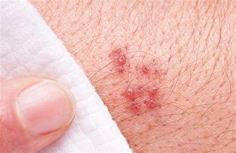 Shingles: Symptoms, Pictures, Risk Factors & Treatment