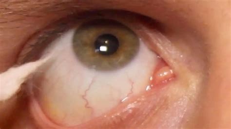 What is the corneal reflex? | Medicine