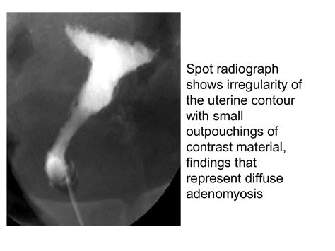 Hysterosalpingography cases