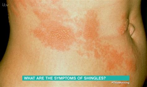 Shingles symptoms: Dr Chris outlines two early signs to spot on ITV ...