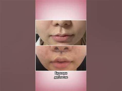 Булхорн до/после ️ https://www.365plastics.co.kr #лечениевкорее # ...
