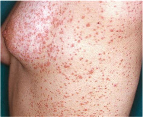 Adverse drug reactions and organ damage: The skin - European Journal of ...