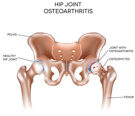 Stages of Osteoarthritis of the Hip | LifeMD