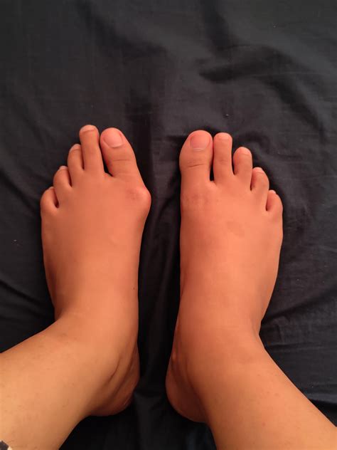 how bad? : r/bunions