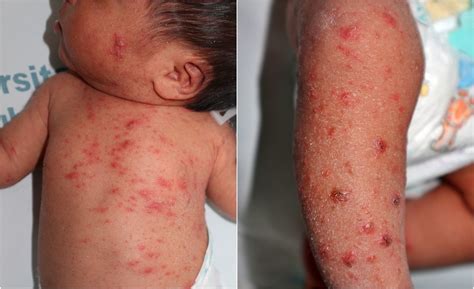 scabies    week  baby boy  diagnostic challenge archives