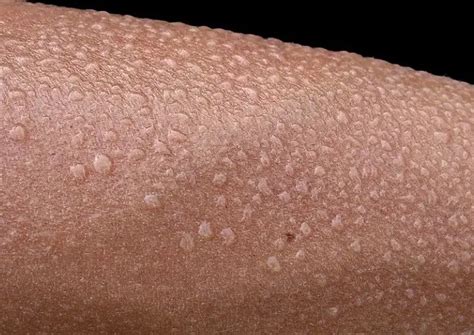 What Is The Difference Between Diaphoresis And Hyperhidrosis ...