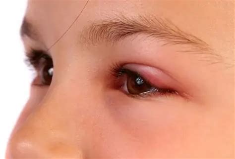 Swollen eyes: causes and treatment | Health