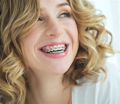 Traditional Braces Wilmington | Orthodontics | Grand Dental – Wilmington