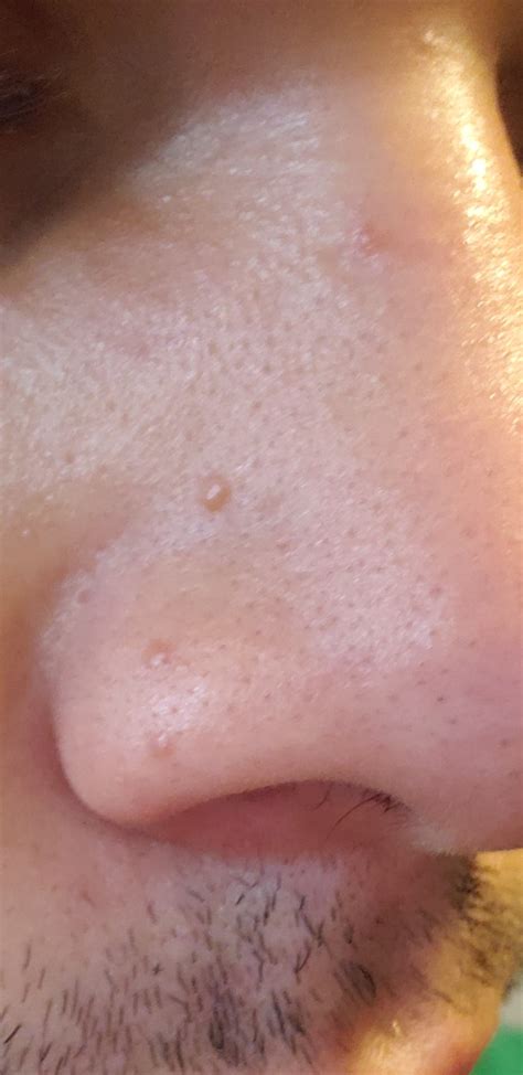 These pimple have started showing up on my nose? Any ideas what they ...