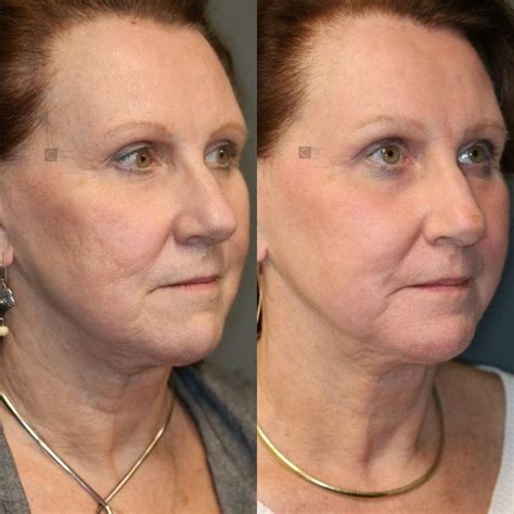 Patient 8560377 | PRP Before & After | Clinic 5C