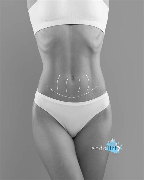 Endolift - 💥 Raffermissement cutané du ventre avec EndoliftX® EndoliftX