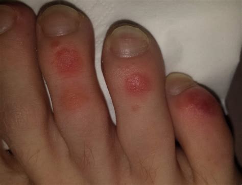 Plötzlich rote (bei Berührung brennende) Flecken an den Zehen? (Füße