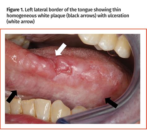 Common white lesions of the oral cavity | The College of Family