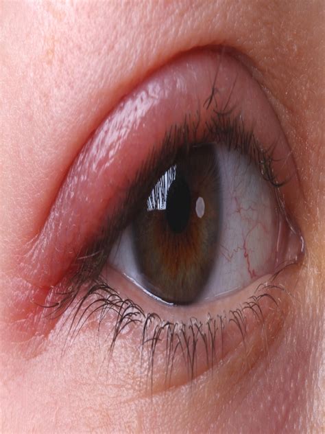 Anterior Blepharitis What is Anterior Blepharitis? Causes & Treatment ...
