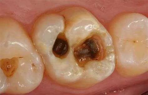 Dental Caries - SofiaDental