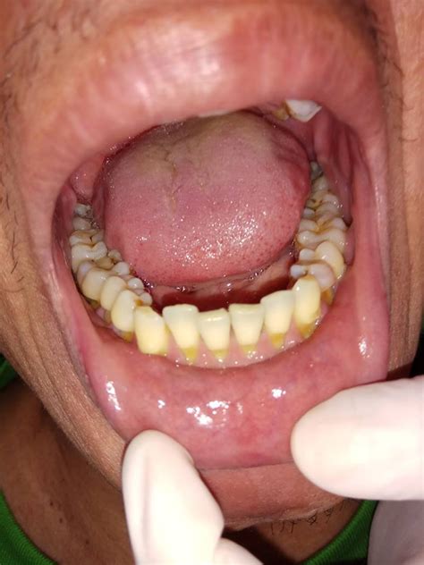 abrasi gigi dental id