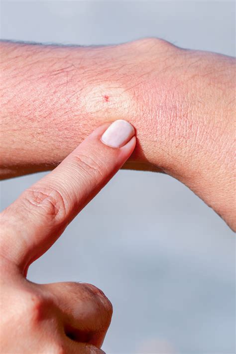 14 Common Bug Bite Pictures - How to ID Insect Bites and Stings