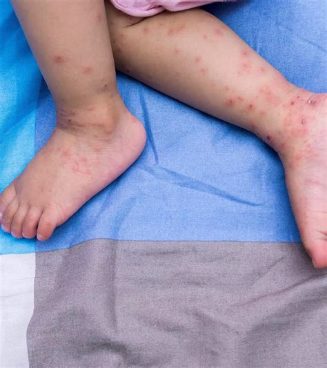 Causes & Signs Of Hand, Foot, And Mouth Disease In Pregnancy