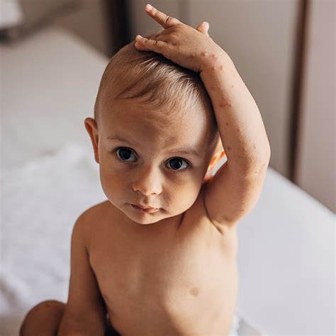 Baby Powder For Hand Foot And Mouth Disease at Cody Learmonth blog