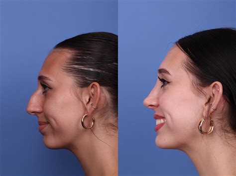 septoplasty     rhinoplasty