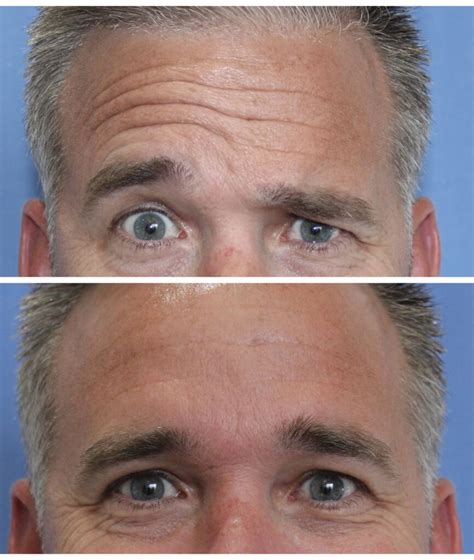 Botox for Men Forehead: Benefits & Process Simplified