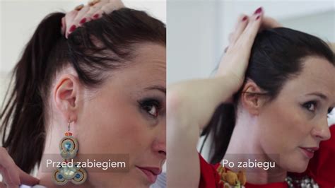 scalp micropigmentation for women - YouTube