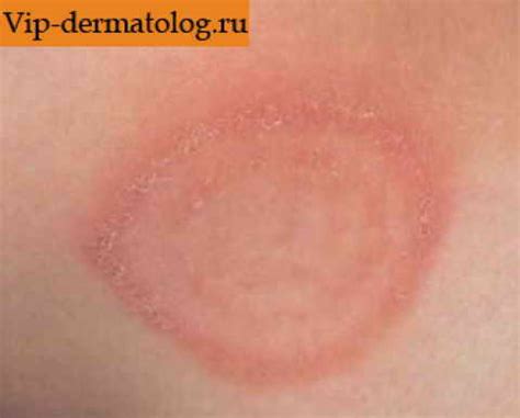 Микроспория гладкой кожи фото. Как выглядит микроспория на фото и под ...