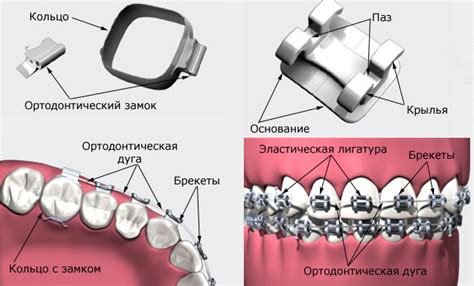 Что такое самолигирующие брекеты? — Дентум Стоматология