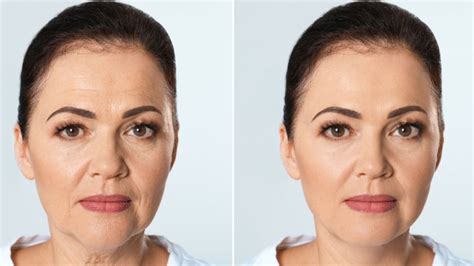 Abaixei A Cabeça Depois Do Botox é Agora - RETOEDU