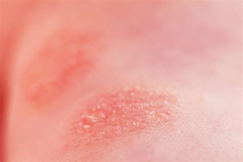 Chocolate allergy: causes, treatments and prevention