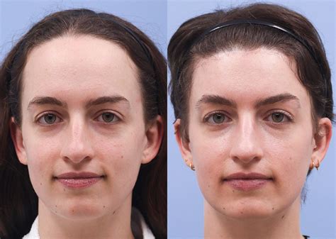 forehead reduction turkey ufuk askeroglu