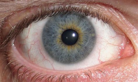 Central Heterochromia: A Rare Eye Condition