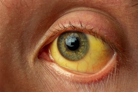 Yellowing Under The Eyes - Infoupdate.org