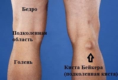 Подколенная киста Бейкера: симптомы, диагностика, лечение в Москве