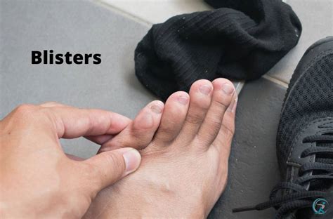 prevent common foot problems  runners tips