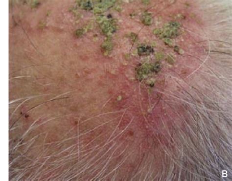 scalp folliculitis | Semantic Scholar