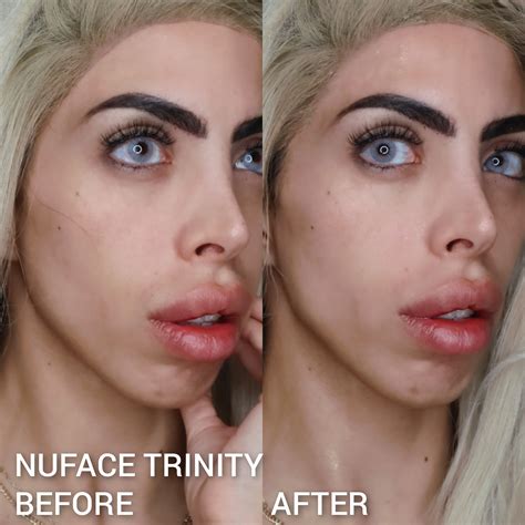 foreo bear  nuface trinity   delivered   results