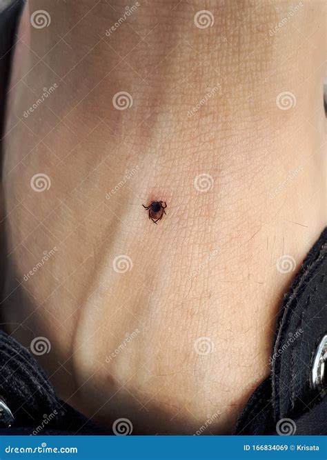 How To Remove Tick Deep In Skin at Hazel Anderson blog