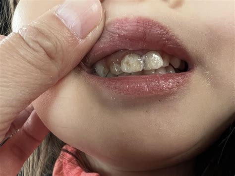 Stain after sdf treatment : r/askdentists