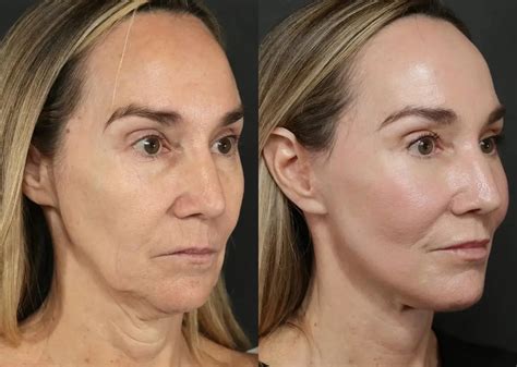 facelift      journey