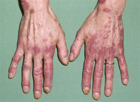 EULAR/ACR Systemic Lupus Erythematosus Classification Criteria Update ...