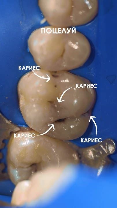 Через поцелуй передается кариес? Его лечение от 1.990r Тел/Wa 8969 ...