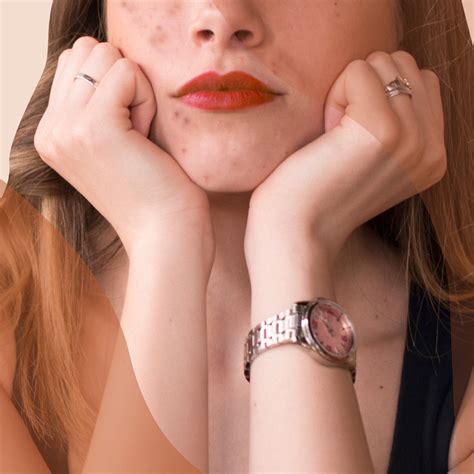Adult Acne: Why Am I Breaking Out, and How Do I Treat It? | Glamour